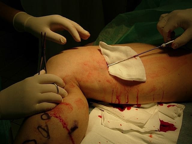 Operacja nogi